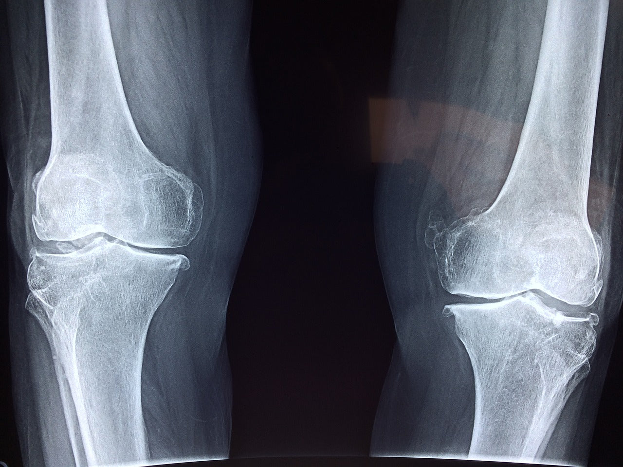 All About Osteoporosis (And How Minerals May Help)